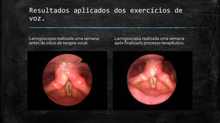 Resultados aplicados dos exercícios de
voz.
Laringoscopia realizada uma semana
antes do início de terapia vocal.
Laringoscopia realizada uma semana
após finalizado processo terapêutico.
 