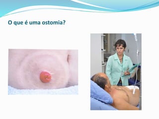 O que é uma ostomia?
 
