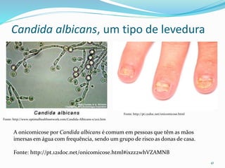 Candida albicans, um tipo de levedura
41
Fonte: http://www.optimalhealthnetwork.com/Candida-Albicans-s/202.htm
Fonte: http://pt.121doc.net/onicomicose.html
A onicomicose por Candida albicans é comum em pessoas que têm as mãos
imersas em água com frequência, sendo um grupo de risco as donas de casa.
Fonte: http://pt.121doc.net/onicomicose.html#ixzz2whVZAMNB
 
