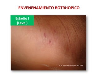 ENVENENAMIENTO	
  BOTRHOPICO	
  
Estadio	
  I	
  	
  
(Leve	
  )	
  
©	
  Dr.	
  Amel	
  J	
  Bracho-­‐Balcázar,	
  MD.	
  FACP	
  
 