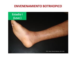ENVENENAMIENTO	
  BOTRHOPICO	
  
Estadio	
  I	
  	
  
(Leve	
  )	
  
©	
  Dr.	
  Amel	
  J	
  Bracho-­‐Balcázar,	
  MD.	
  FACP	
  
 