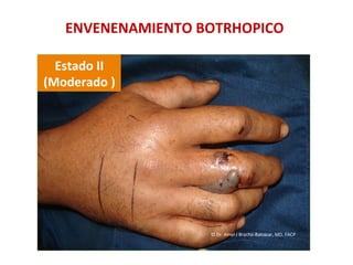 Estado	
  II	
  	
  
(Moderado	
  )	
  
ENVENENAMIENTO	
  BOTRHOPICO	
  
©	
  Dr.	
  Amel	
  J	
  Bracho-­‐Balcázar,	
  MD.	
  FACP	
  
 