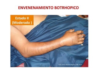 ENVENENAMIENTO	
  BOTRHOPICO	
  
Estado	
  II	
  	
  
(Moderado	
  )	
  
©	
  Dr.	
  Amel	
  J	
  Bracho-­‐Balcázar,	
  MD.	
  FACP	
  
 