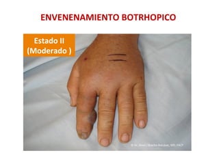ENVENENAMIENTO	
  BOTRHOPICO	
  
Estado	
  II	
  	
  
(Moderado	
  )	
  
©	
  Dr.	
  Amel	
  J	
  Bracho-­‐Balcázar,	
  MD.	
  FACP	
  
 