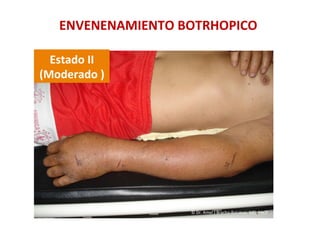 ENVENENAMIENTO	
  BOTRHOPICO	
  
Estado	
  II	
  	
  
(Moderado	
  )	
  
©	
  Dr.	
  Amel	
  J	
  Bracho-­‐Balcázar,	
  MD.	
  FACP	
  
 
