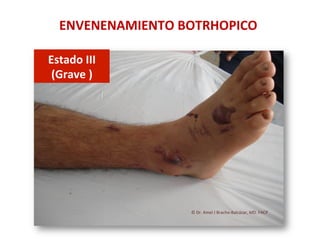ENVENENAMIENTO	
  BOTRHOPICO	
  
Estado	
  III	
  	
  
(Grave	
  )	
  
©	
  Dr.	
  Amel	
  J	
  Bracho-­‐Balcázar,	
  MD.	
  FACP	
  
 