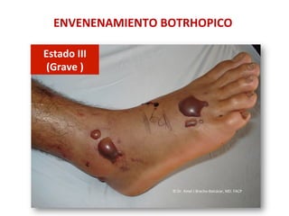 ENVENENAMIENTO	
  BOTRHOPICO	
  
Estado	
  III	
  	
  
(Grave	
  )	
  
©	
  Dr.	
  Amel	
  J	
  Bracho-­‐Balcázar,	
  MD.	
  FACP	
  
 