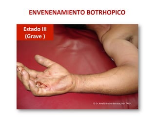 ENVENENAMIENTO	
  BOTRHOPICO	
  
Estado	
  III	
  	
  
(Grave	
  )	
  
©	
  Dr.	
  Amel	
  J	
  Bracho-­‐Balcázar,	
  MD.	
  FACP	
  
 