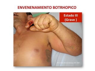 ENVENENAMIENTO	
  BOTRHOPICO	
  
Estado	
  III	
  	
  
(Grave	
  )	
  
©	
  Dr.	
  Amel	
  J	
  Bracho-­‐Balcázar,	
  MD.	
  FACP	
  
 