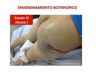 Estado	
  III	
  	
  
(Grave	
  )	
  
ENVENENAMIENTO	
  BOTRHOPICO	
  
©	
  Dr.	
  Amel	
  J	
  Bracho-­‐Balcázar,	
  MD.	
  FACP	
  
 