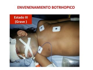 ENVENENAMIENTO	
  BOTRHOPICO	
  
Estado	
  III	
  	
  
(Grave	
  )	
  
©	
  Dr.	
  Amel	
  J	
  Bracho-­‐Balcázar,	
  MD.	
  FACP	
  
 