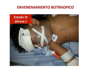 ENVENENAMIENTO	
  BOTRHOPICO	
  
Estado	
  III	
  	
  
(Grave	
  )	
  
©	
  Dr.	
  Amel	
  J	
  Bracho-­‐Balcázar,	
  MD.	
  FACP	
  
 