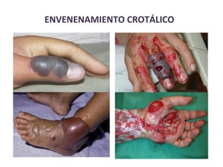 ENVENENAMIENTO	
  CROTÁLICO	
  
 