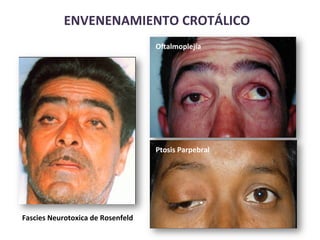 Fascies	
  Neurotoxica	
  de	
  Rosenfeld	
  
OYalmoplejía	
  
Ptosis	
  Parpebral	
  
ENVENENAMIENTO	
  CROTÁLICO	
  
 