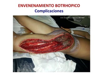©	
  Dr.	
  Amel	
  J	
  Bracho-­‐Balcázar,	
  MD.	
  FACP	
  
ENVENENAMIENTO	
  BOTRHOPICO	
  
Complicaciones	
  
 