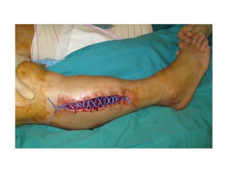 Accidente Ofídico  2015