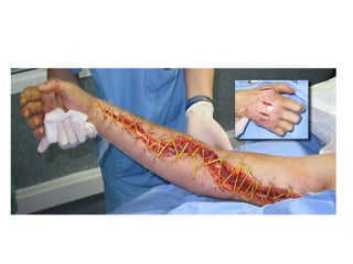 Accidente Ofídico  2015