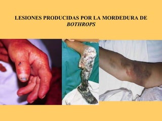 LESIONES PRODUCIDAS POR LA MORDEDURA DE
BOTHROPS
 