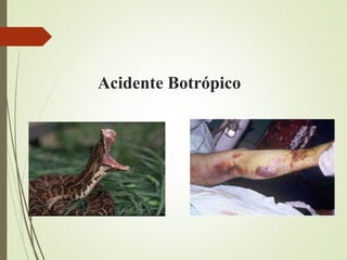 Acidente Botrópico
 