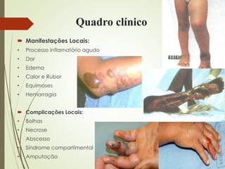 Quadro clínico
 Manifestações Locais:
• Processo inflamatório agudo
• Dor
• Edema
• Calor e Rubor
• Equimoses
• Hemorragia
 Complicações Locais:
• Bolhas
• Necrose
• Abscesso
• Síndrome compartimental
• Amputação
 