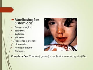 Manifestações
Sistêmicas:
• Gengivorragias;
• Epistaxes;
• Sudorese;
• Náuseas;
• Hipotensão arterial;
• Hipotermia;
• Hemoglobinúria;
• Choques.
Complicações: Choques( graves) e Insuficiência renal aguda (IRA).
 