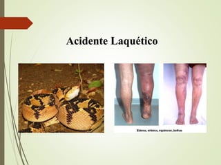 Acidente Laquético
 