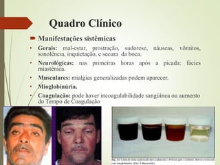 Quadro Clínico
 Manifestações sistêmicas
• Gerais: mal-estar, prostração, sudorese, náuseas, vômitos,
sonolência, inquietação, e secura da boca.
• Neurológicas: nas primeiras horas após a picada: fácies
miastênica.
• Musculares: mialgias generalizadas podem aparecer.
• Mioglobinúria.
• Coagulação: pode haver incoagulabilidade sangüínea ou aumento
do Tempo de Coagulação
 (TC)
 