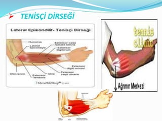  TENİSÇİ DİRSEĞİ
 