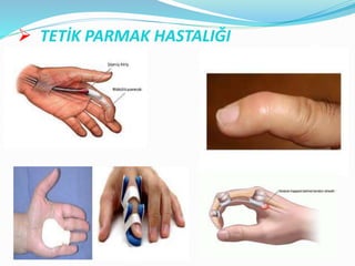  TETİK PARMAK HASTALIĞI
 