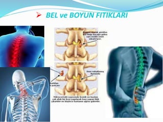  BEL ve BOYUN FITIKLARI
 