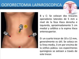 Ooforectomia 