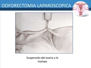 SALPINGOOFORECTOMIA (CIRUGÍA DE EXTIRPACIÓN DE OVARIOS) – Cirugía