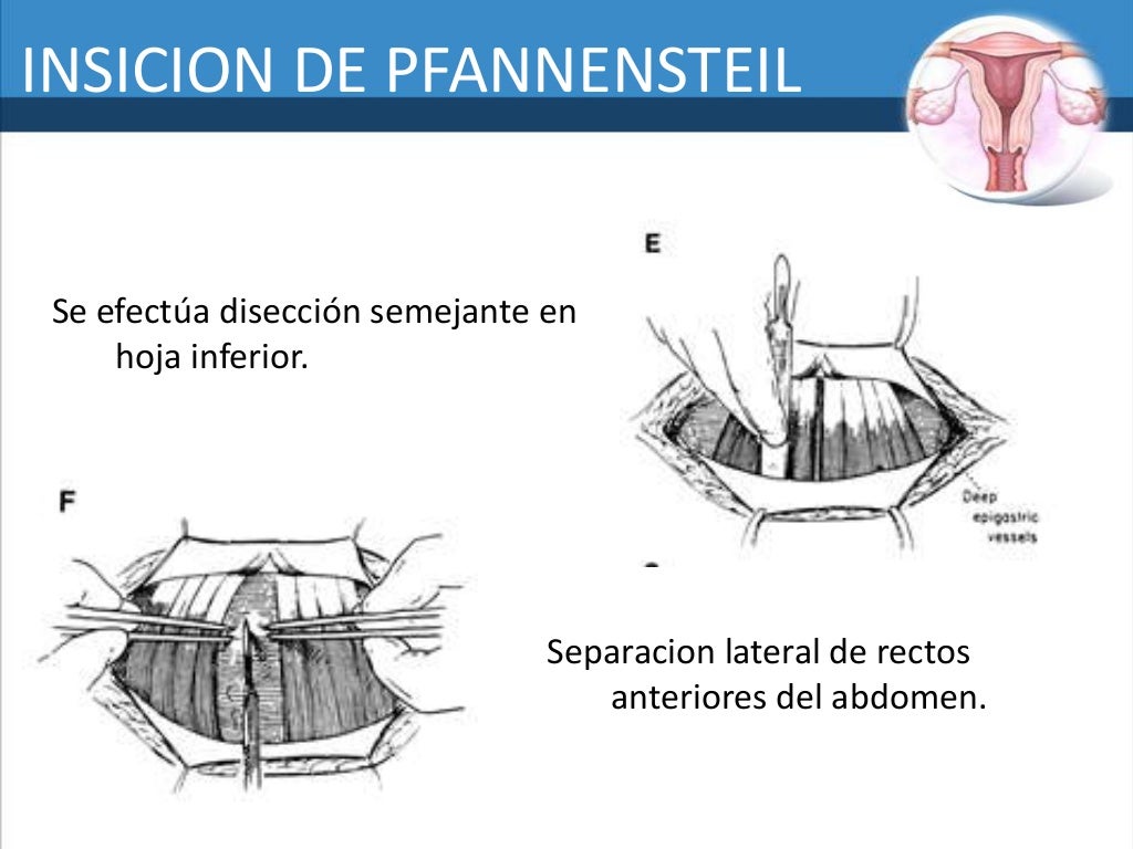 Oforosalgingectomia jonathan molina