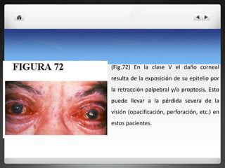 (Fig.72) En la clase V el daño corneal
resulta de la exposición de su epitelio por
la retracción palpebral y/o proptosis. Esto
puede llevar a la pérdida severa de la
visión (opacificación, perforación, etc.) en
estos pacientes.

 