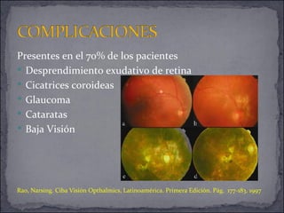 Presentes en el 70% de los pacientes Desprendimiento exudativo de retina Cicatrices coroideas Glaucoma Cataratas Baja Visión Rao, Narsing. Ciba Visión Opthalmics, Latinoamérica. Primera Edición. Pág.  177-183 .  1997 