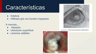 Características
● Indolora
● Infiltrado gris con bordes irregulares
A menudo...
● Hipopión
● Ulceración superficial
● Lesiones satélites
 