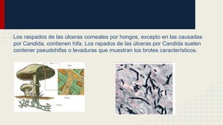 Los raspados de las úlceras corneales por hongos, excepto en las causadas
por Candida, contienen hifa. Los rapados de las úlceras por Candida suelen
contener pseudohifas o levaduras que muestran los brotes característicos.
 