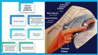 Cierre
angular
primario
Bloqueo pupilar
Adhesión del
cristalino a la pupila
Aumento de presión
en el segmento
posterior de la
cámara anterior
Abombamiento del
iris hacia adelante
Bloqueo relacionado
con la inserción
anatómica del iris o
con la morfología del
iris
Obstrucción
trabecular
 