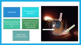 Fotofobia
Córnea opaca y
grisácea
Pupila midriática,
no reactiva a la
luz
Presión del ojo al
palparlo con los
dedos se nota
aumentada
Hiperemia
periquerática
 
