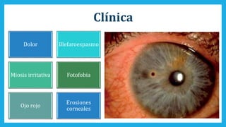 Clínica
Dolor Blefaroespasmo
Miosis irritativa Fotofobia
Ojo rojo
Erosiones
corneales
 