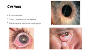 Corneal
• Abrasión corneal
• Edema corneal agudo secundario
• Desgarros de la membrana de descemet
 