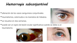 Hemorragia subconjuntival
•alteración de los vasos sanguíneos conjuntivales
•traumatismos, estornudos o la maniobra de Valsalva.
•se resuelve en dos semanas.
•puede ser un signo de lesión ocular significativa cuando se debe a un
traumatismo.
 