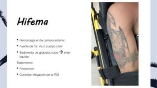 Hifema
• Hemorragia en la camara anterior
• Fuente de hx: iris o cuerpo ciliar
• Sedimento de globulos rojos  nivel
liquído
Tratamiento:
• Prevención
• Controlar elevación de la PIO
 