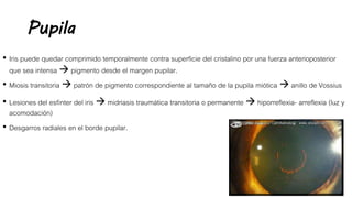 Pupila
• Iris puede quedar comprimido temporalmente contra superficie del cristalino por una fuerza anterioposterior
que sea intensa  pigmento desde el margen pupilar.
• Miosis transitoria  patrón de pigmento correspondiente al tamaño de la pupila miótica  anillo de Vossius
• Lesiones del esfínter del iris  midriasis traumática transitoria o permanente  hiporreflexia- arreflexia (luz y
acomodación)
• Desgarros radiales en el borde pupilar.
 