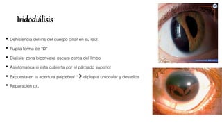 Iridodiálisis
• Dehisiencia del iris del cuerpo ciliar en su raiz
• Pupila forma de “D”
• Dialisis: zona biconvexa oscura cerca del limbo
• Asintomatica si esta cubierta por el párpado superior
• Expuesta en la apertura palpebral  diplopía uniocular y destellos
• Reparación qx.
 