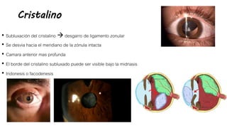 Cristalino
• Subluxación del cristalino  desgarro de ligamento zonular
• Se desvia hacia el meridiano de la zónula intacta
• Camara anterior mas profunda
• El borde del cristalino subluxado puede ser visible bajo la midriasis
• Iridonesis o facodenesis
 