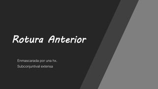 Rotura Anterior
Enmascarada por una hx.
Subconjuntival extensa
 