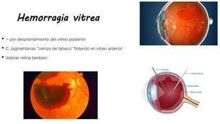 Hemorragia vitrea
• > por desprendimiento del vítreo posterior
• C. pigmentarias “ceniza de tabaco” flotando en vitreo anterior
• Valorar retina tambien
 