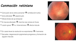 Conmoción retiniana
• Concusión de la retina sensorial  tumefacción turbia
• Zona afectada  aspecto gris
• Afecta fondo de ojo temporal
• Si macula afectada  mancha rojo cereza en fovea
• Lesión grave  hx. Intrarretiniana  afecta mácula
• En casos leves la resolución es espontanea  6 semanas
• Secuelas: degeneración pigmentaria progresiva y formación de
agujero macular.
 