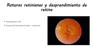 Roturas retinianas y desprendimiento de
retina
• Traumatismos 10%
• Causa mas frecuente en niños < masculino
 